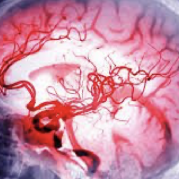 fractura vertebral  DOCTORA ESPINO NEUROCIRUJANO