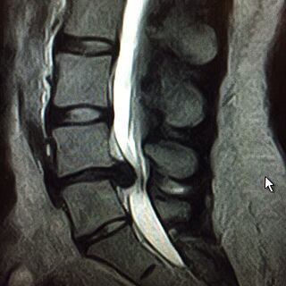 hernia de disco DOCTORA ESPINO NEUROCIRUJANO