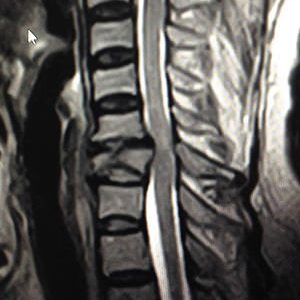 fractura vertebral  DOCTORA ESPINO NEUROCIRUJANO